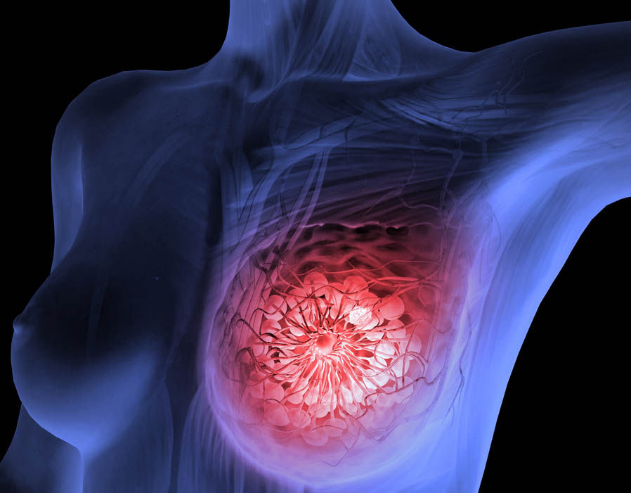 Καρκίνος μαστού: Ποιες γυναίκες κινδυνεύουν περισσότερο - Media