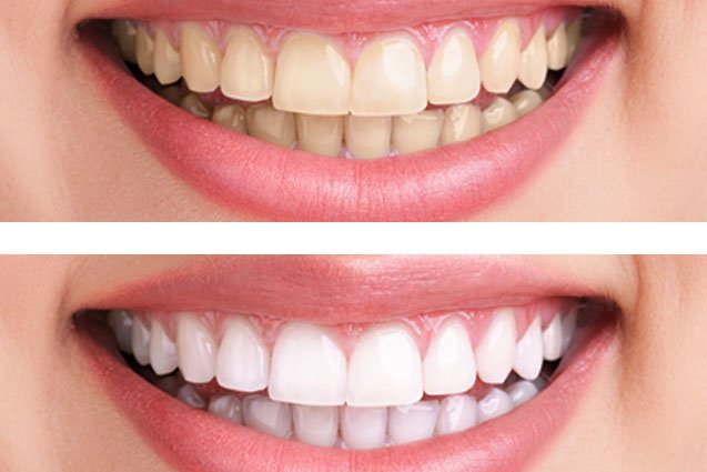 Λεύκανση δοντιών: Το σπιτικό προϊόν που κάνει... θαύματα! - Media